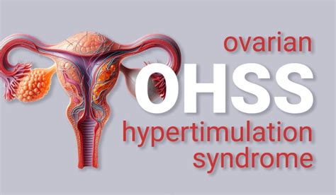 Syndróm ovariálnej hyperstimulácie (OHSS) pri asistovanej reprodukcii